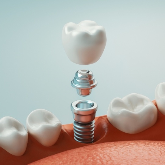 Illustrated dental implant and crown replacing a missing tooth