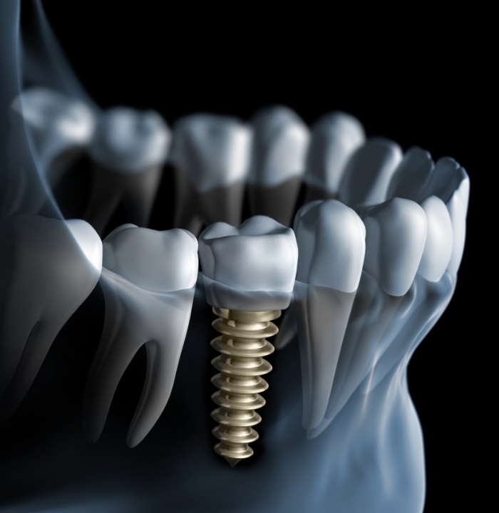Illustrated X ray of a person with a dental implant
