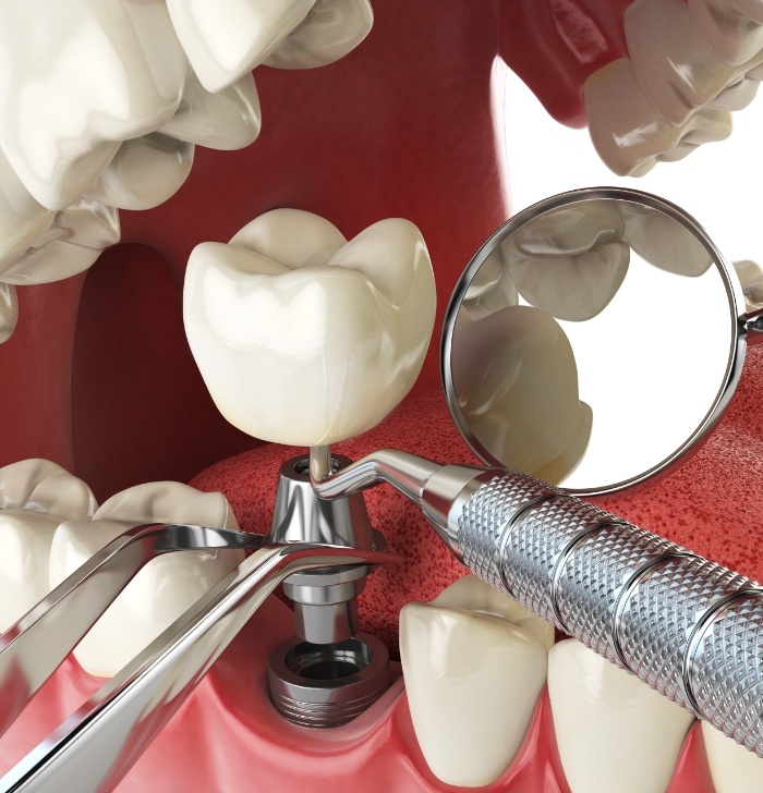 Illustrated dental implant with abutment and crown being placed