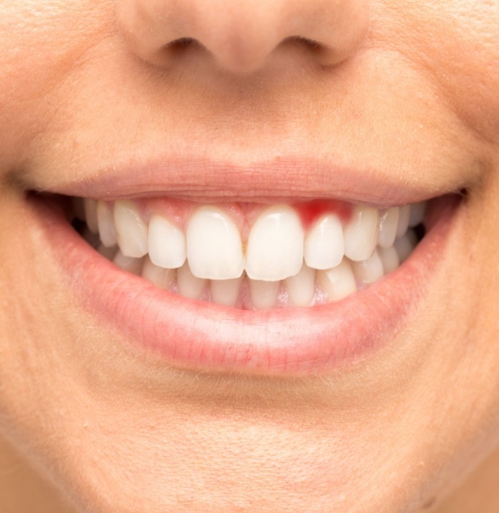 Close up of person smiling with red spot in their gums