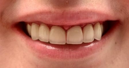Close up of complete aligned smile after treatment from Mansfield dentist