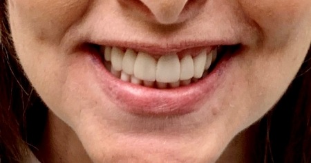Woman smiling with a confident full set of teeth