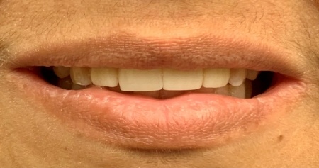Person smiling after replacing one missing upper tooth