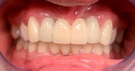 Mouth with a complete set of white teeth
