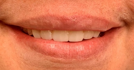 Smile with a well aligned upper row of teeth