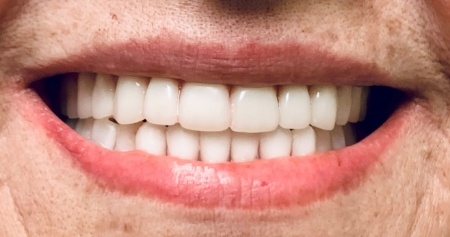 Senior woman with a full set of bright white teeth