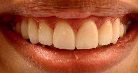 Smile after removing yellow stains from teeth