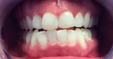 Mouth with whiter teeth