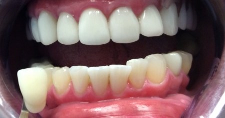Veneer in front of mouth with whiter teeth