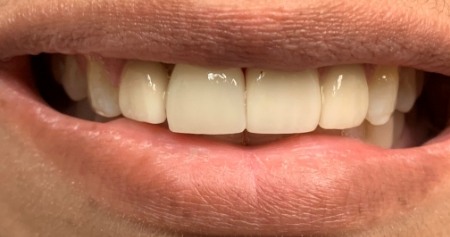 Close up of smile after tooth replacement