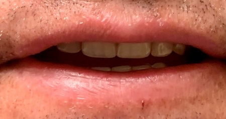 Smile after replacing multiple missing teeth
