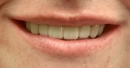 Smile with a complete set of replacement teeth
