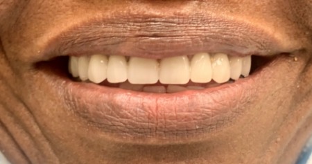 Smile with an even row of lower teeth