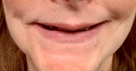 Woman smiling with some missing teeth