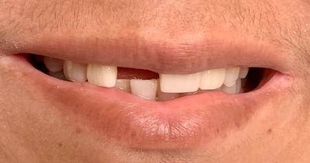 Person smiling with one missing upper tooth