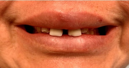 Smile with misaligned upper teeth