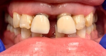 Smile with several old dental crowns