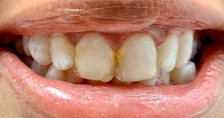 Smile with yellow stains on teeth