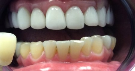 Veneer in front of mouth with discolored teeth