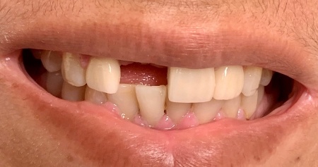 Close up of smile missing one upper tooth