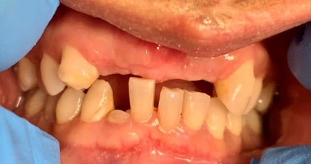 Mouth with several missing teeth along both arches