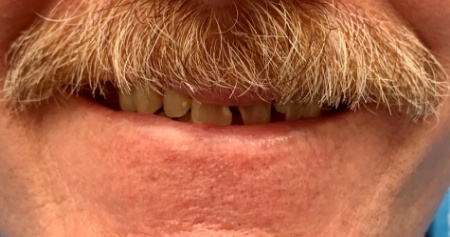 Man with mustache smiling with a few missing teeth