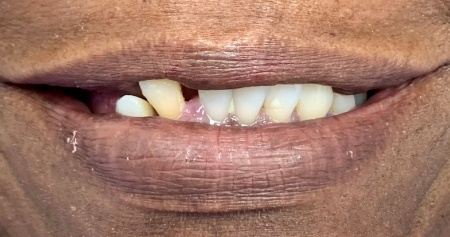 Smile with misaligned lower teeth