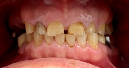 Smile with yellowed and damaged teeth