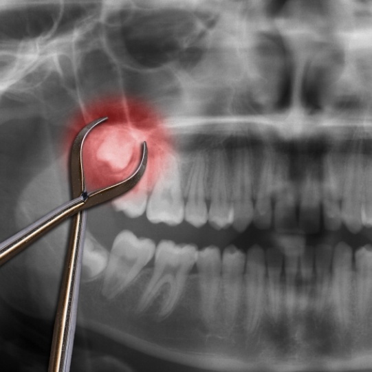Dental forceps in front of x ray of teeth with wisdom tooth highlighted red