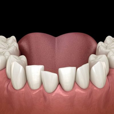 Illustration of crowded teeth in lower dental arch