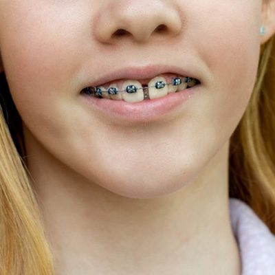 Girl with braces on her gapped teeth